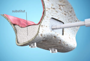 Implant dentaire 77