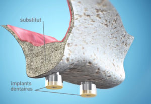Implant dentaire 77