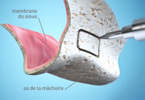 Implant dentaire 77